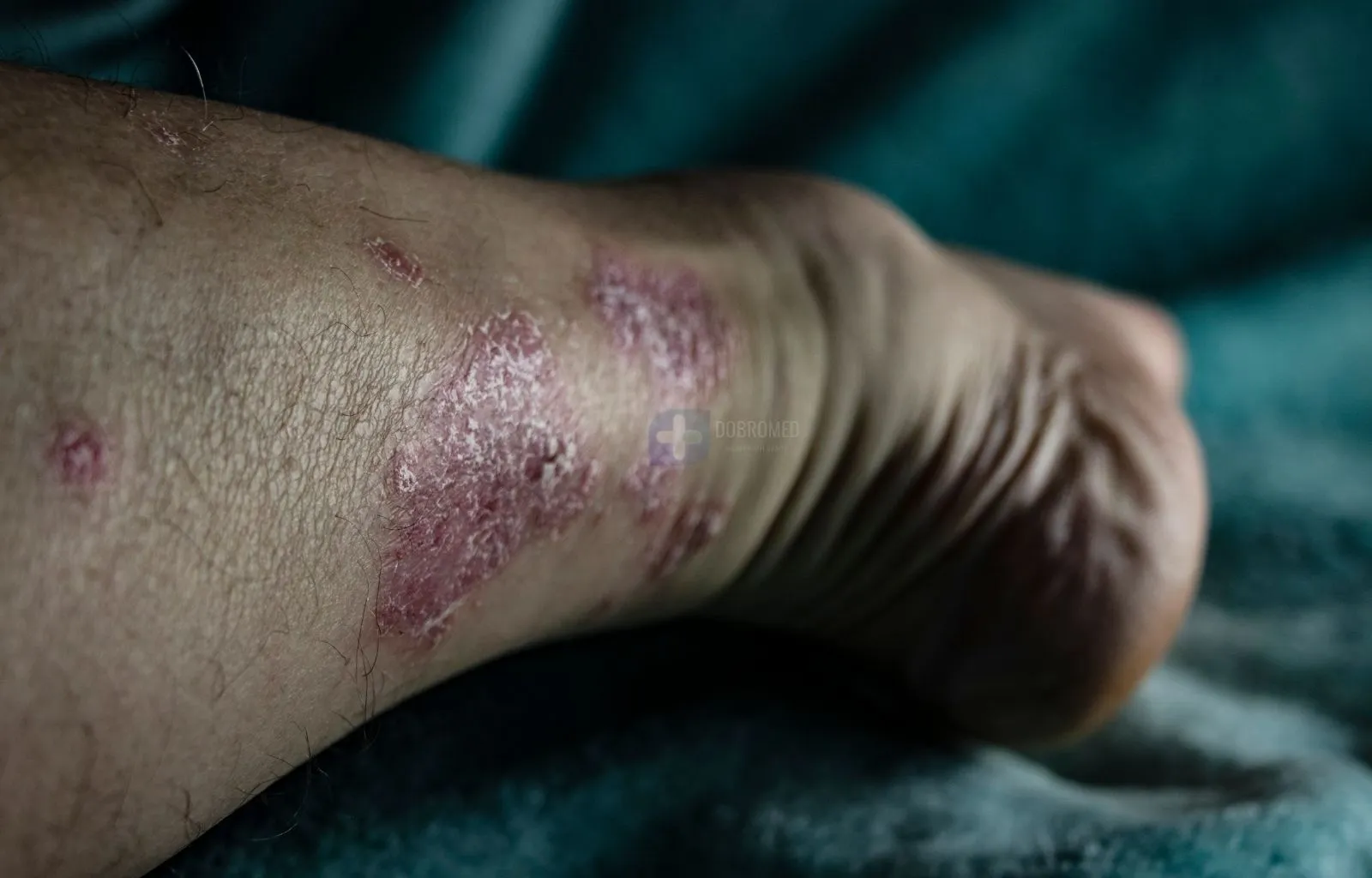 Консультація нарколога щодо кодування при супутніх захворюваннях